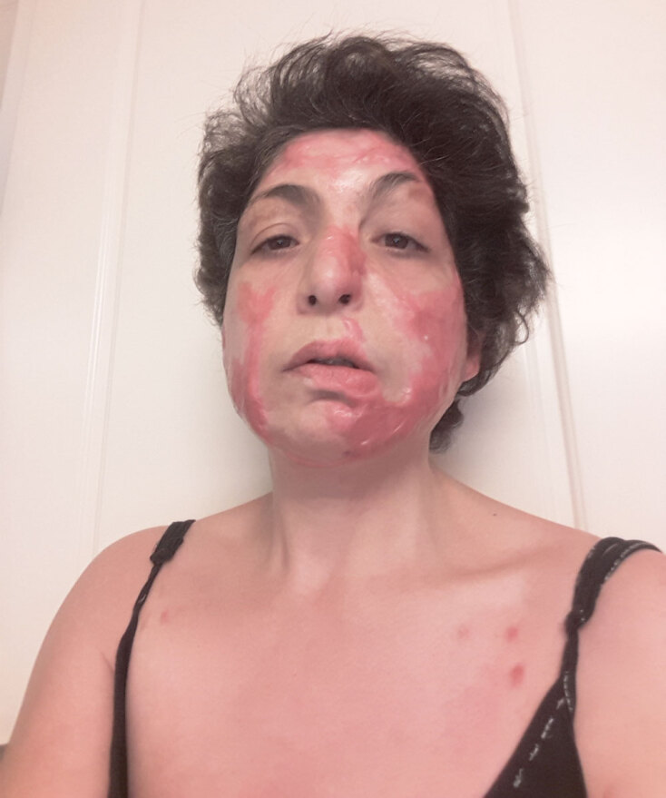 Η Άρτεμις Καψύλη, με εγκαύματα τρίτου βαθμού στο πρόσωπο, χρειάστηκε να κάνει πολλά χειρουργεία