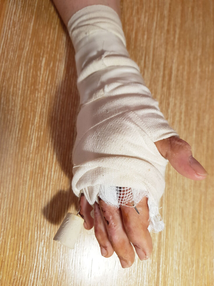 Το χέρι της Άρτεμις Καψύλη λίγο μετά από ένα χειρουργείο αποκατάστασης