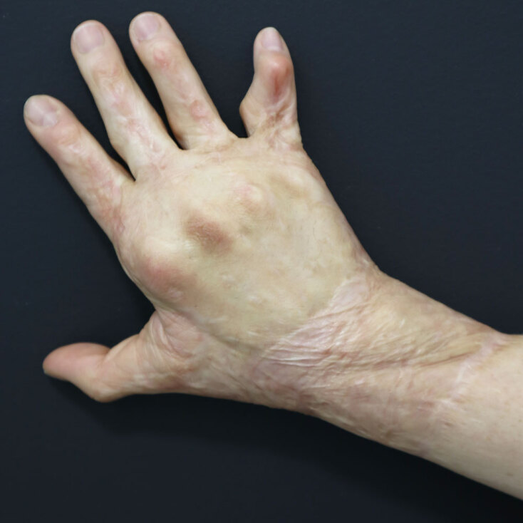 Το χέρι της Άρτεμις Καψύλη μετά από χειρουργείο αποκατάστασης