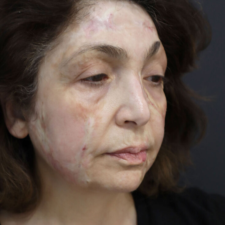 Άρτεμις Καψύλη: Ο αγώνας της αποκατάστασης είναι μακρύς και δύσκολος, αλλά η θέληση για ζωή είναι πιο δυνατή