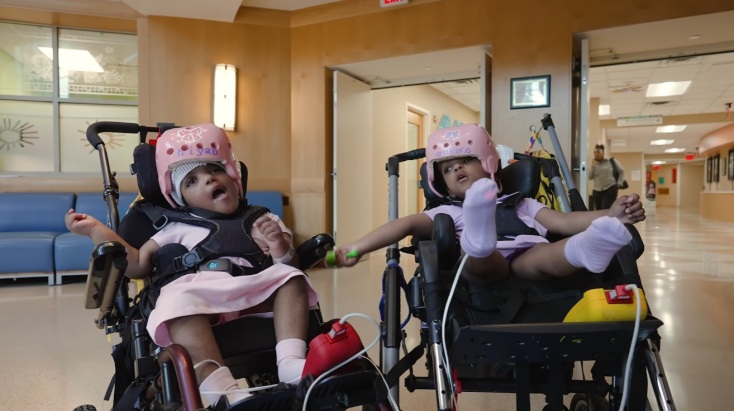 ΗΠΑ: Σπάνια 24ωρη χειρουργική επέμβαση διαχώρισε σιαμαία κοριτσάκια ενωμένα στο κεφάλι