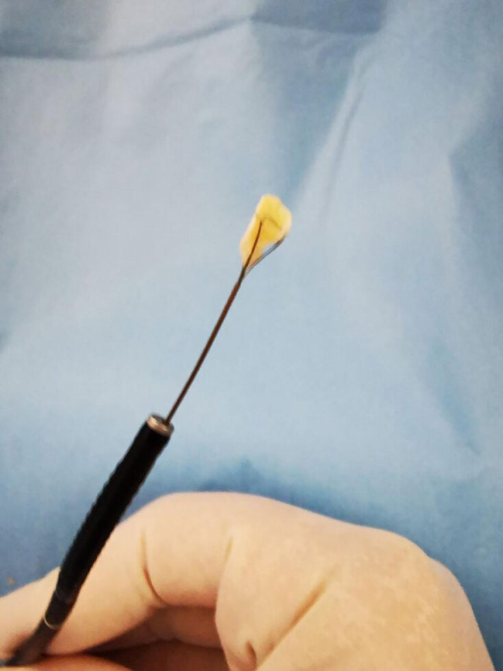 Ένα καρύδι παραλίγο να σκοτώσει τον μικρό Οδυσσέα από την Πάτρα  