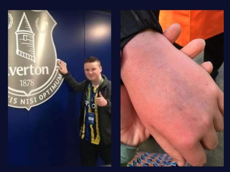 Το αυτιστικό παιδί και οι μώλωπες στο χέρι του μετά το χτύπημα από τον Κριστιανό Ρονάλντο