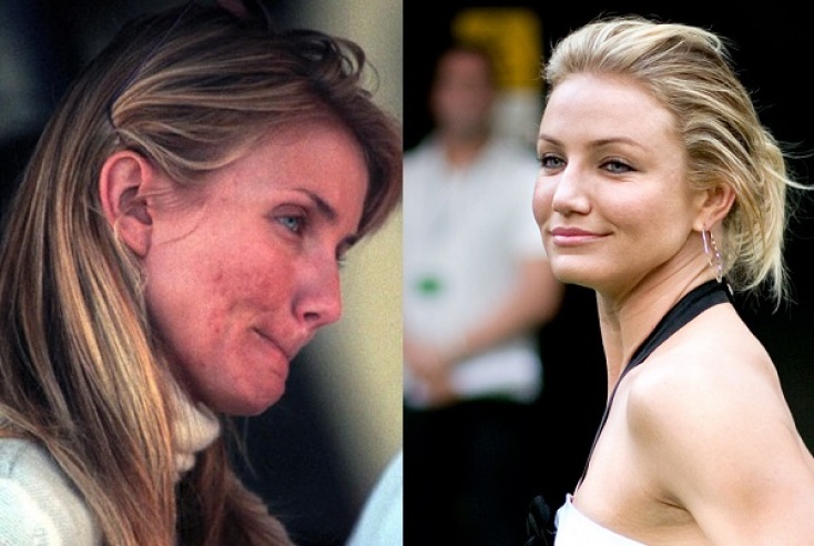 cameron-diaz-acne-scars.jpg