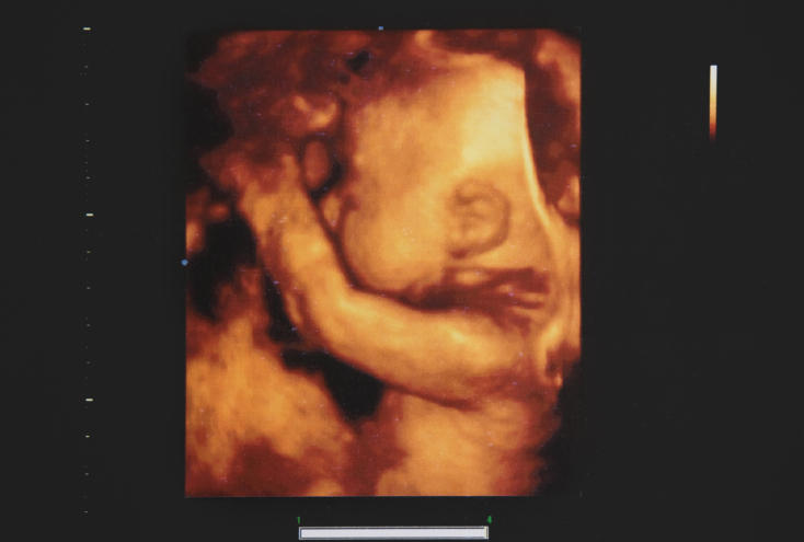 Φωτογραφία υπερηχογραφήματος μωρού