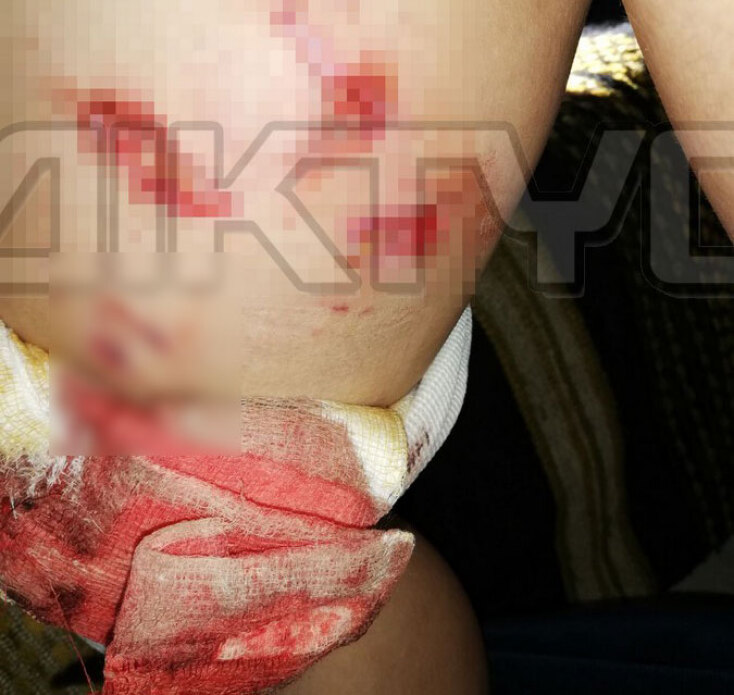 Σέρρες: 11χρονος δέχτηκε επίθεση από πιτ μπουλ