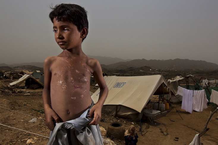 50.000 παιδιά στην Υεμένη θα πεθάνουν σε 45 μέρες 