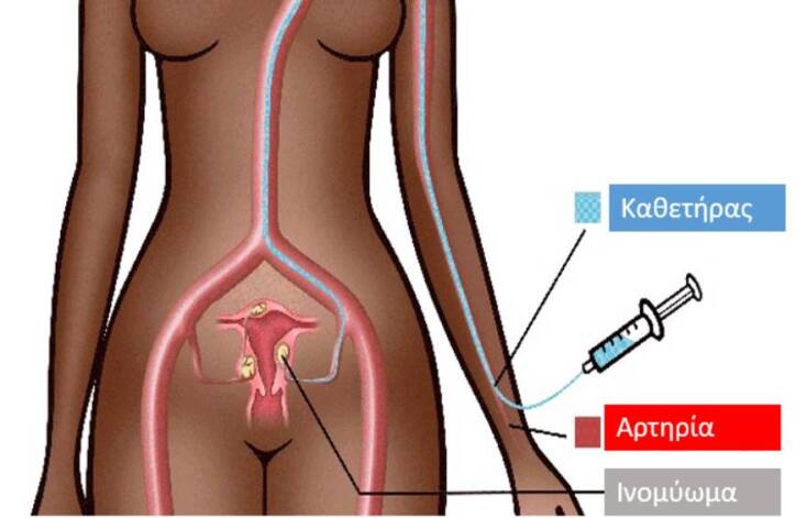 Διαδερμικός εμβολισμός των ινομυωμάτων και λαπαροσκοπική μυομεκτομή