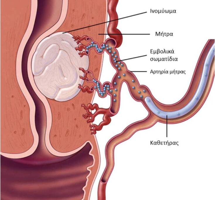 Διαδερμικός εμβολισμός των ινομυωμάτων και λαπαροσκοπική μυομεκτομή