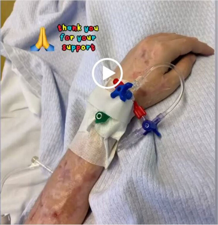 Η Ιωάννα έδειξε το χέρι της, το οποίο είναι γεμάτο εγκαύματα μετά την επίθεση με βιτριόλι στην Καλλιθέα