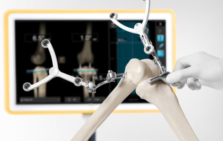 Ένα προηγμένο σύστημα πλοήγησης το οποίο εξασφαλίζει απόλυτη ακρίβεια σε επεμβάσεις αρθροπλαστικής γόνατος.