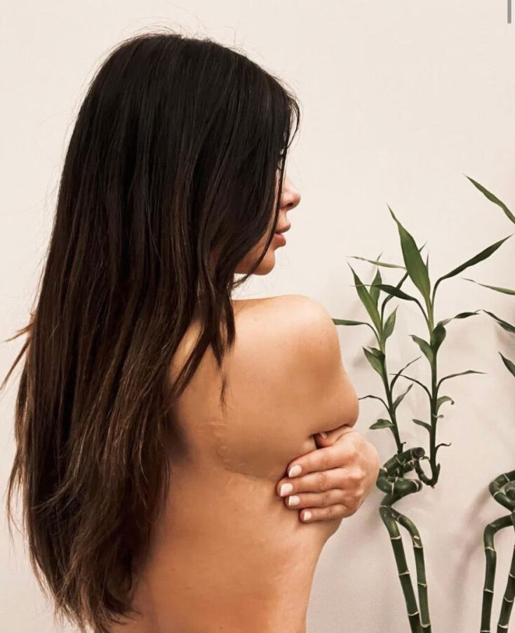 Τα σημάδια στην πλάτη που έχει η Μίνα Αρναούτη μετά το τροχαίο