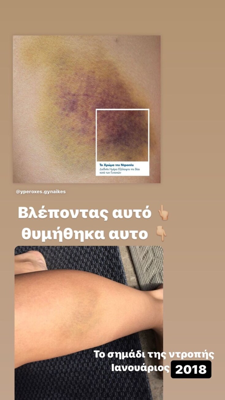 Σοφία Παυλίδου: Δείχνει τη μελανιά στο πόδι της μετά το περιστατικό βίας που υπέστη