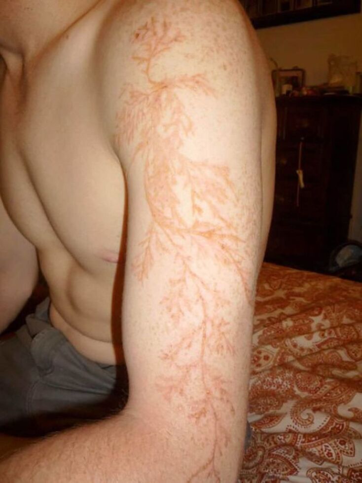 scars-after-surviving-lightning-strike-lichtenberg-figures-photos-1-5b6d30a7bab41_700.jpg