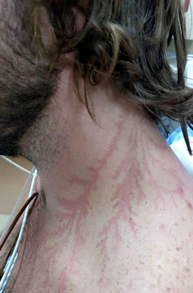 scars-after-surviving-lightning-strike-lichtenberg-figures-photos-12-5b6d30e63a74b_700.jpg