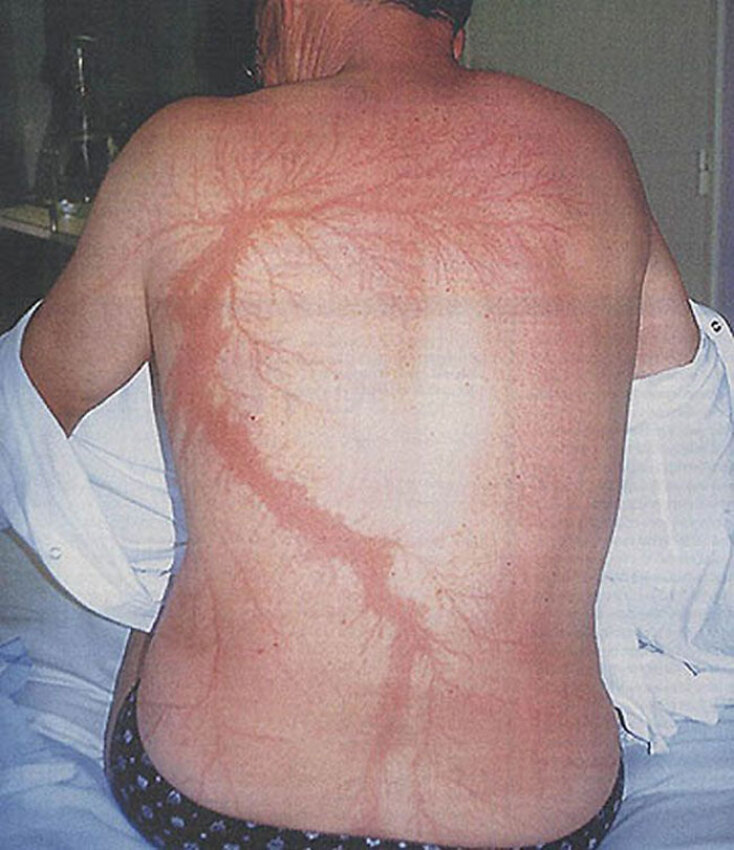 scars-after-surviving-lightning-strike-lichtenberg-figures-photos-17-5b6d30af76710_700.jpg