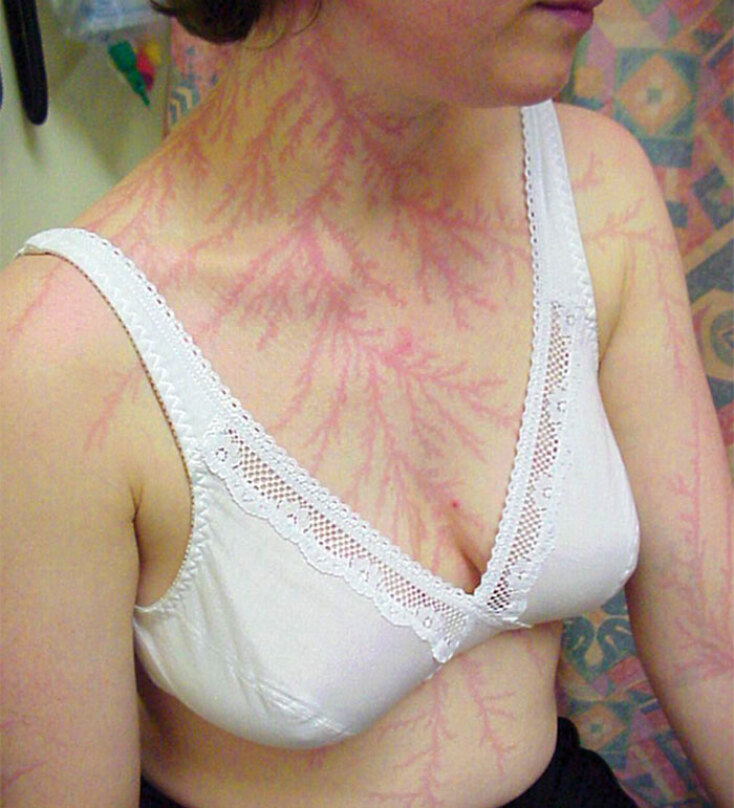 scars-after-surviving-lightning-strike-lichtenberg-figures-photos-18.jpg