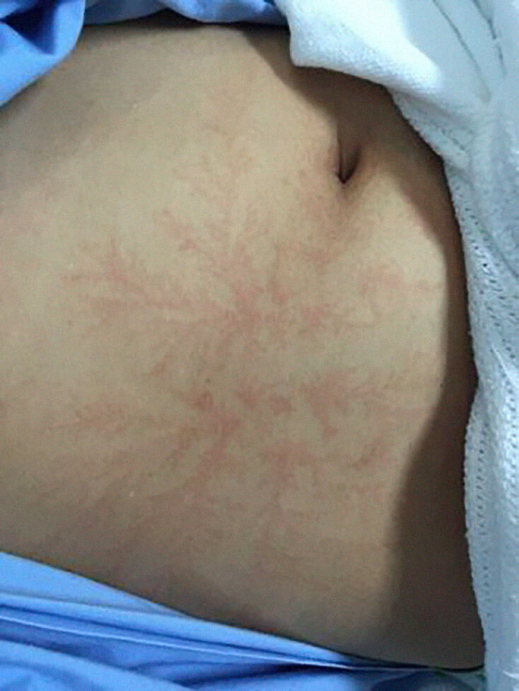 scars-after-surviving-lightning-strike-lichtenberg-figures-photos-2-5b6d30d5451fd_700.jpg