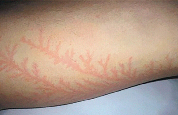 scars-after-surviving-lightning-strike-lichtenberg-figures-photos-3-5b6d321fb308f_700.jpg
