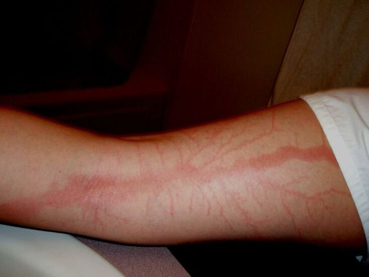 scars-after-surviving-lightning-strike-lichtenberg-figures-photos-4-5b6d30d915d3d_700.jpg