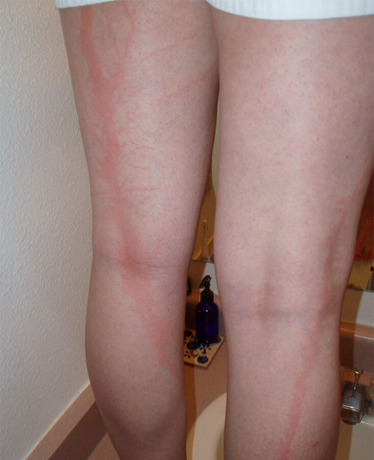 scars-after-surviving-lightning-strike-lichtenberg-figures-photos-5b6d3b9c1db61_700.jpg