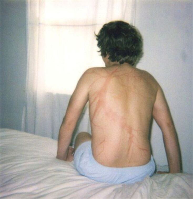 scars-after-surviving-lightning-strike-lichtenberg-figures-photos-8-5b6d30dfb628a_700.jpg