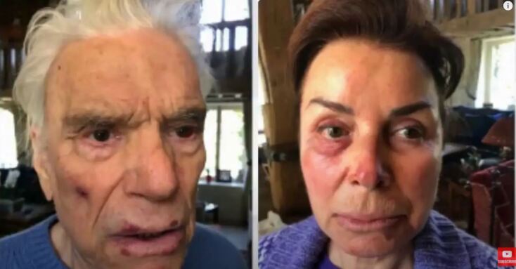 Σημάδια από τα χτυπήματα που δέχθηκαν στο πρόσωπο του ζεύγους