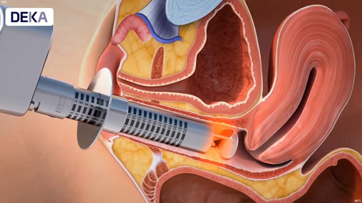 Ατροφία κόλπου – Χαλάρωση κόλπου: Αντιμετώπιση με την τεχνολογία Mona Lisa Touch Laser