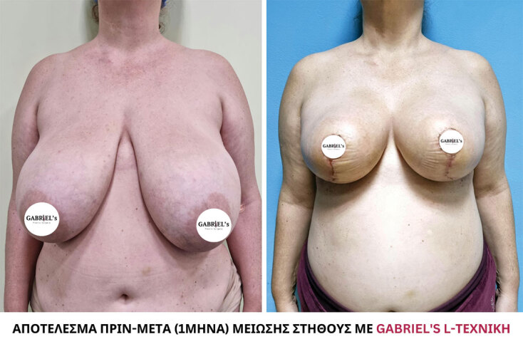 Αποτέλεσμα Πριν και Μετά μείωσης στήθους με Gabriels-L τεχνική