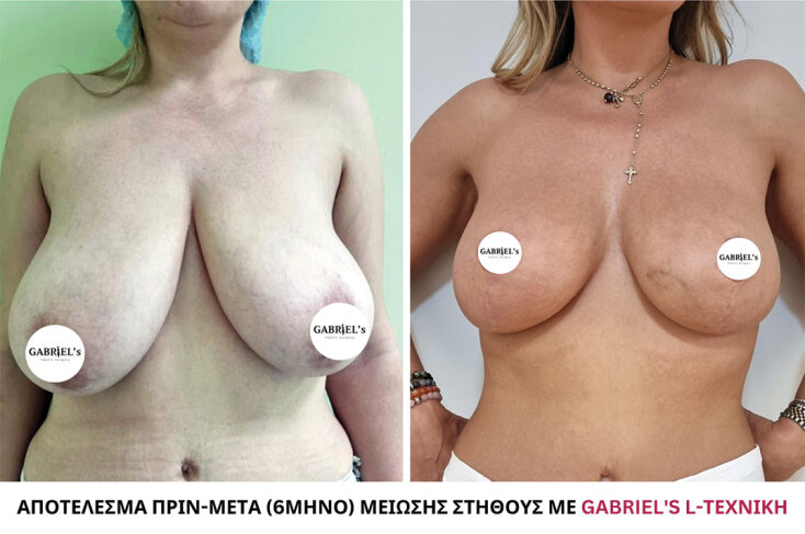 Αποτέλεσμα Πριν και Μετά μείωσης στήθους με Gabriels-L τεχνική