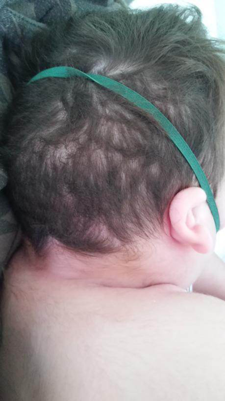 Μια μητέρα - φροντίστρια διηγείται την εμπειρία της: πώς απέκτησε και πώς έχασε το παιδί της που έπασχε από το σύνδρομο «Split Hand Foot Malformation 5»