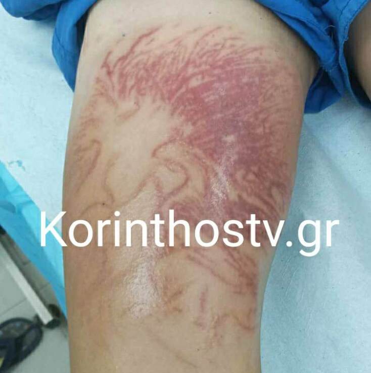 Θαλάσσια ανεμώνη, ο νέος κίνδυνος του βυθού