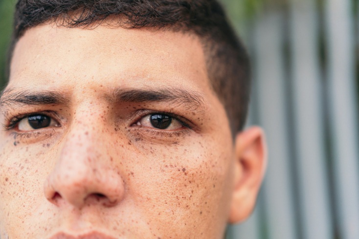 ΗΠΑ: Χειρουργοί στη Νέα Υόρκη μεταμόσχευσαν για πρώτη φορά με επιτυχία ολόκληρο οφθαλμικό βολβό σε έναν ασθενή - Τι σηματοδοτεί η εξέλιξη. 