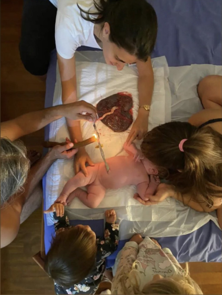 Το κάψιμο του ομφάλιου λώρου