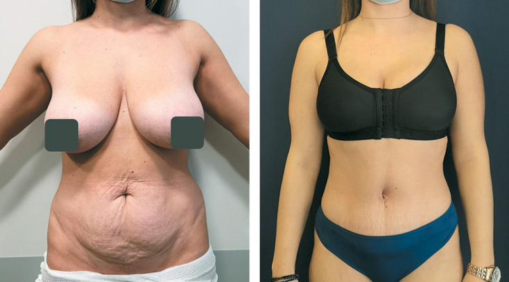 «Mommy Makeover»: Επανόρθωση μετά από εγκυμοσύνη