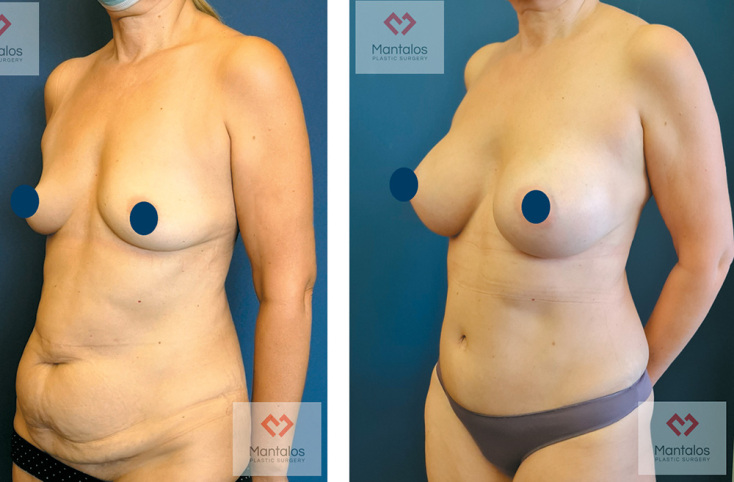 «Mommy Makeover»: Επανόρθωση μετά από εγκυμοσύνη