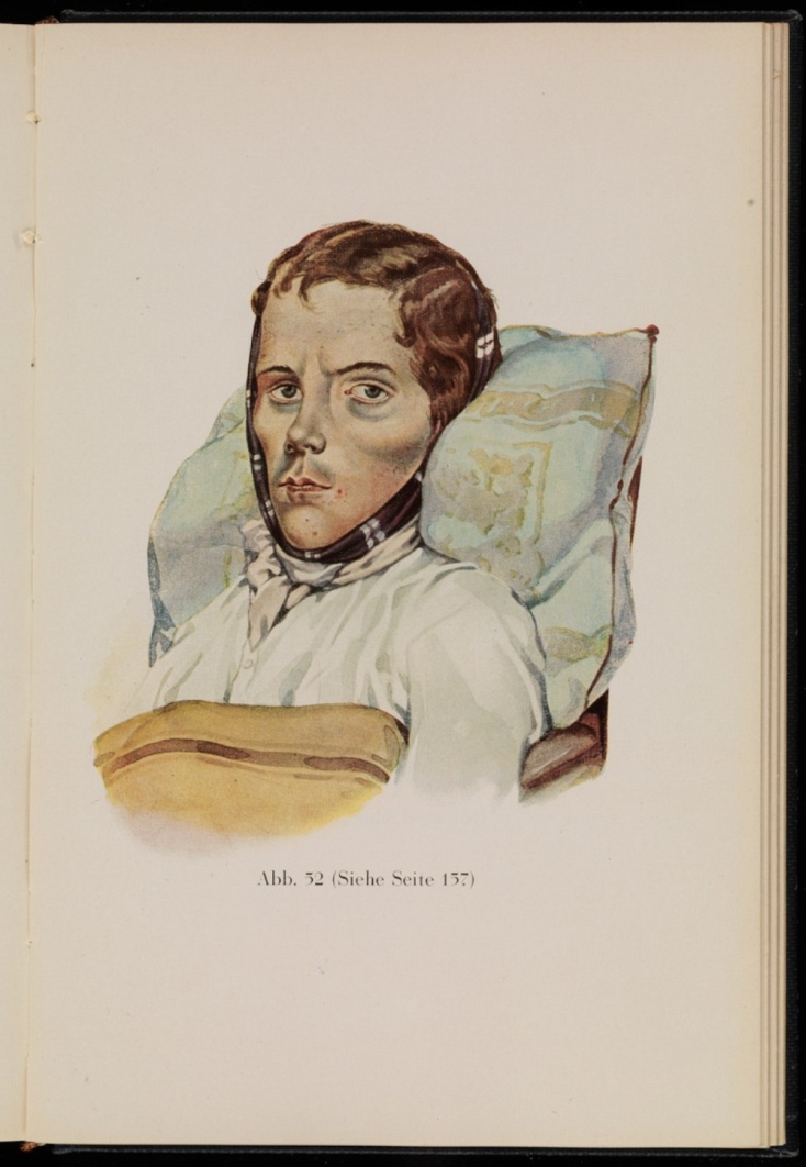 Γιώργος Καλτσάκας: «Η ιστορία της φυματίωσης είναι η ιστορία της ανθρωπότητας»