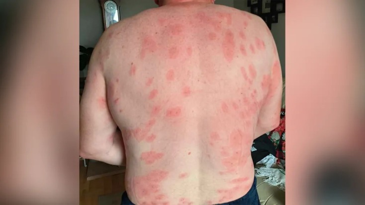 Τα σημάδια από την επίθεση σφηκών 