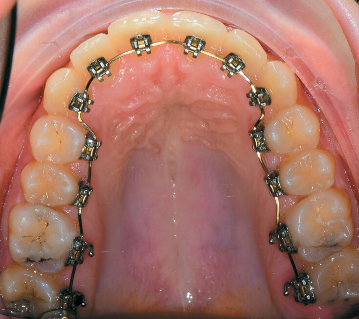 Νέες εξελίξεις στην ορθοδοντική ενηλίκων