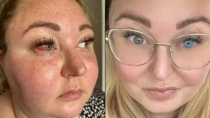 Η γυναίκα που έχασε το μάτι της από την πλέον σπάνια ασθένεια 