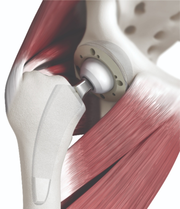 Αρθροπλαστική ισχίου