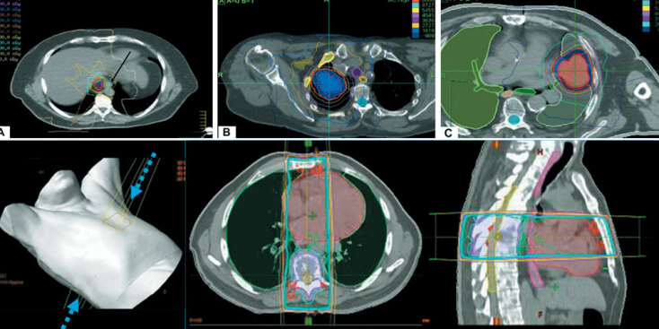 Στερεοτακτική Ακτινοχειρουργική