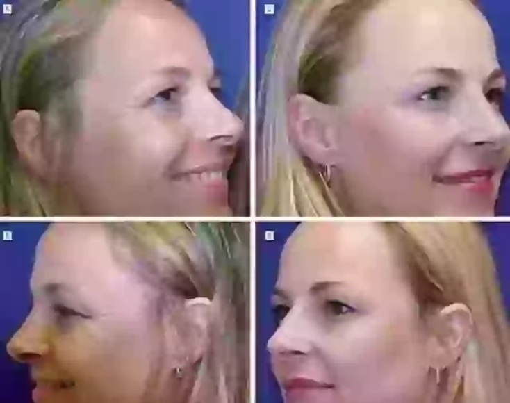 Μελέτη σε αποκαλύπτει τις μακροχρόνιες επιπτώσεις του μπότοξ - Επιστήμονες παρακολούθησαν δύο δίδυμες αδελφές επί 20 χρόνια