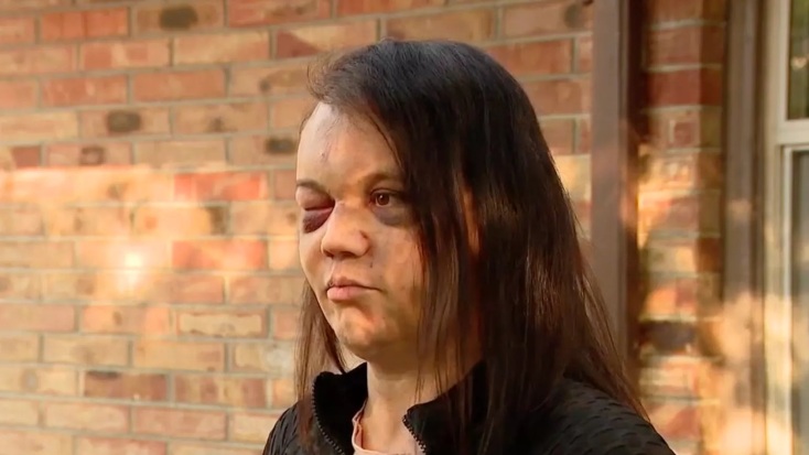 Βίαιη επίθεση σε τρανς γυναίκα στο Σιάτλ - Συνελήφθησαν τέσσερις ύποπτοι, η Νίκι Άρμστρονγκ δηλώνει πως δεν νιώθει ασφαλής στις ΗΠΑ.