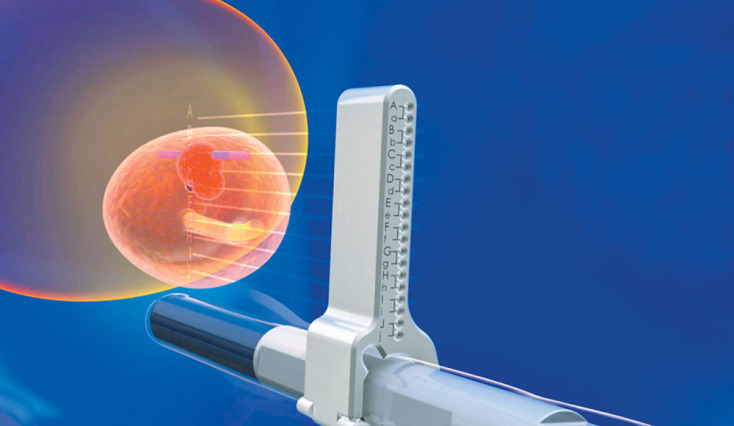 Καρκίνος του προστάτη: Η νέα τεχνική για τη διάγνωσή του