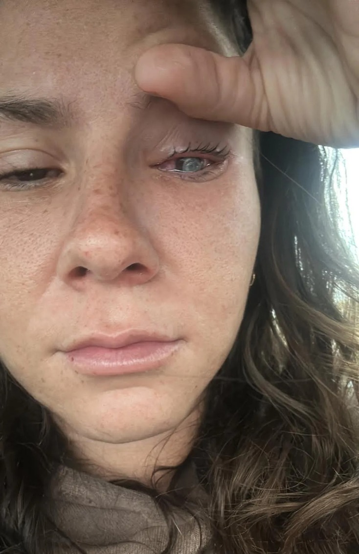 Η νεαρή γυναίκα μοιράστηκε την περιπέτεια απώλειας της όρασής της 