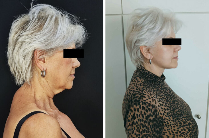 Deep Plane Face & Neck Lift