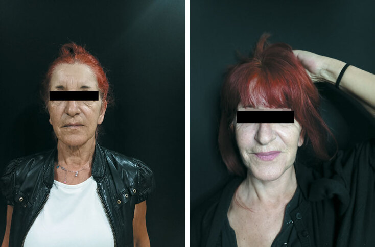 Deep Plane Face & Neck Lift