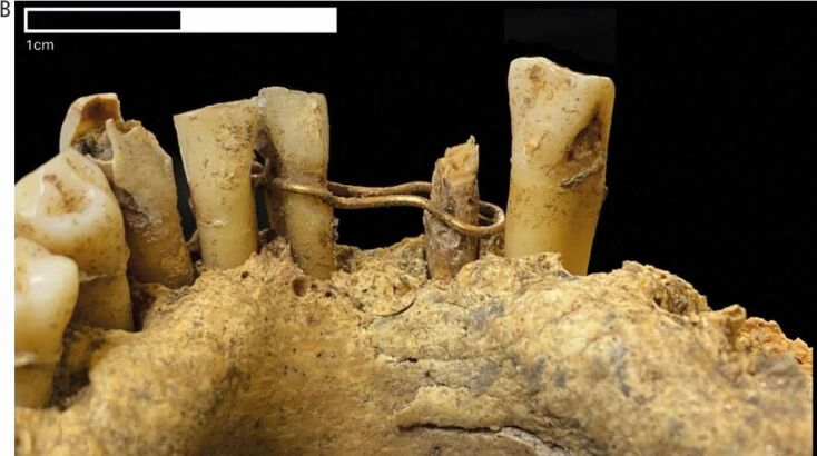 Χρυσή «οδοντιατρική γέφυρα» 500 ετών αποκαλύπτει άγνωστες πρακτικές στη Σκωτία