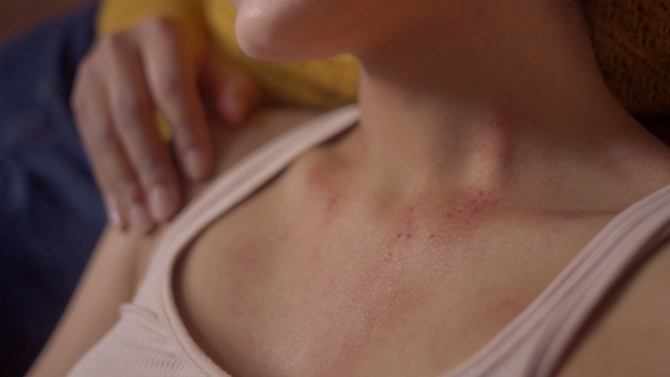 Δερματική φροντίδα σε καρκινοπαθείς